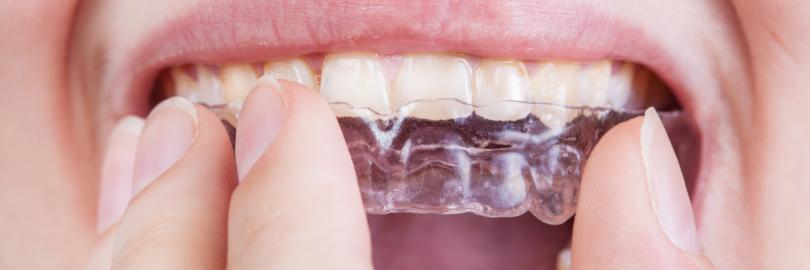 Eine Frau hat eine durchsichtige Zahnspange in der Hand und hält sie sich vor den Mund.